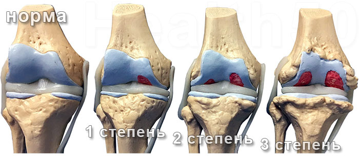 Лечение артроза коленных суставов - лечение гонартроза 
