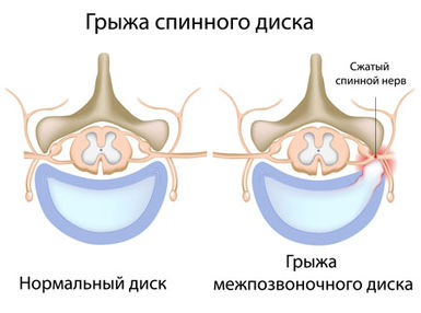 Лечение грыжи 