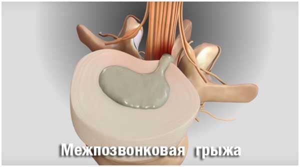 Лечение грыжи поясничного отдела позвоночника 