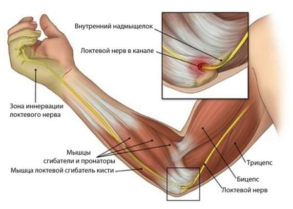 Лечение и профилактика тендинита локтевого сустава 