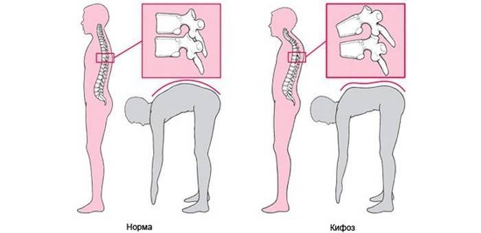 Лечение кифоза грудного отдела позвоночника 