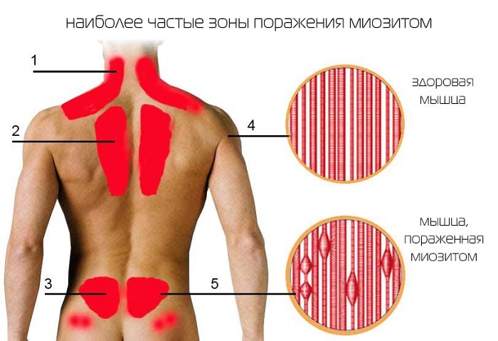 Лечение миозита шеи в домашних условиях 