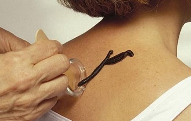 Лечение остеохондроза шейного отдела пиявками — польза и вред 