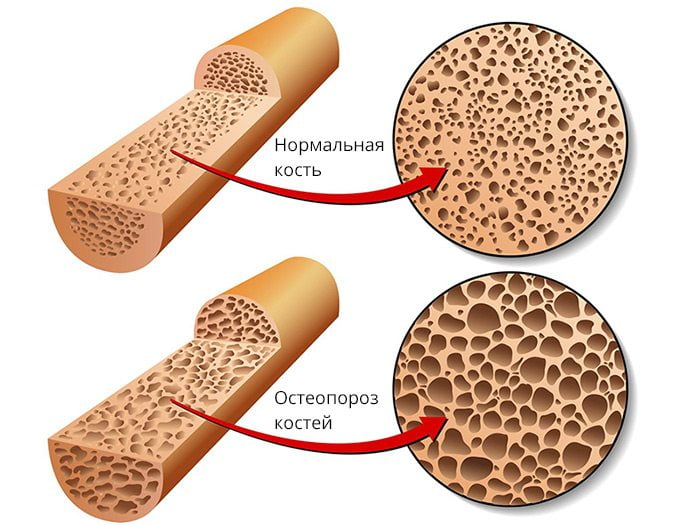 Лечение остеопороза позвоночника: симптоматика, гимнастика, диета 