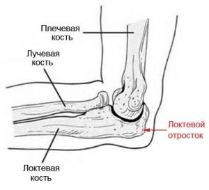 Лечение перелома локтевого отростка и восстановление после травмы 