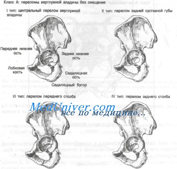 Лечение переломов вертлужной впадины 
