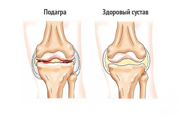 Лечение подагры травяным сбором 