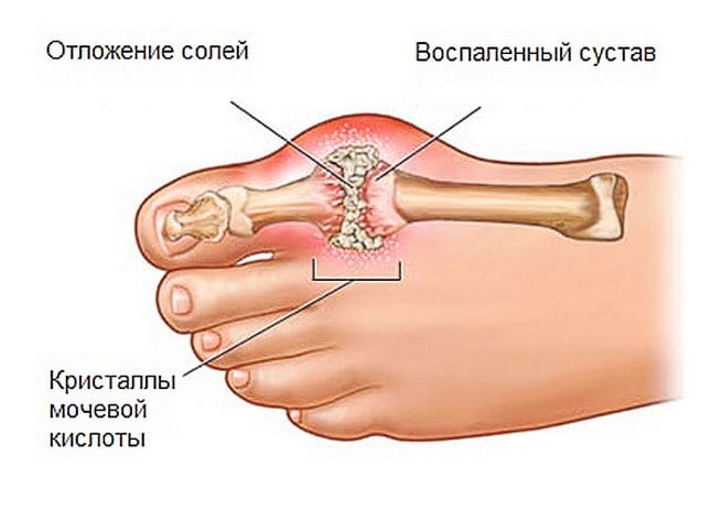 Лечение подагры в домашних условиях 