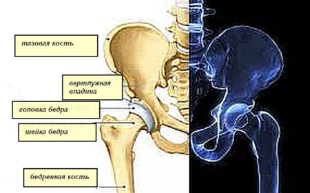 Лечение подвывиха тазобедренного сустава 