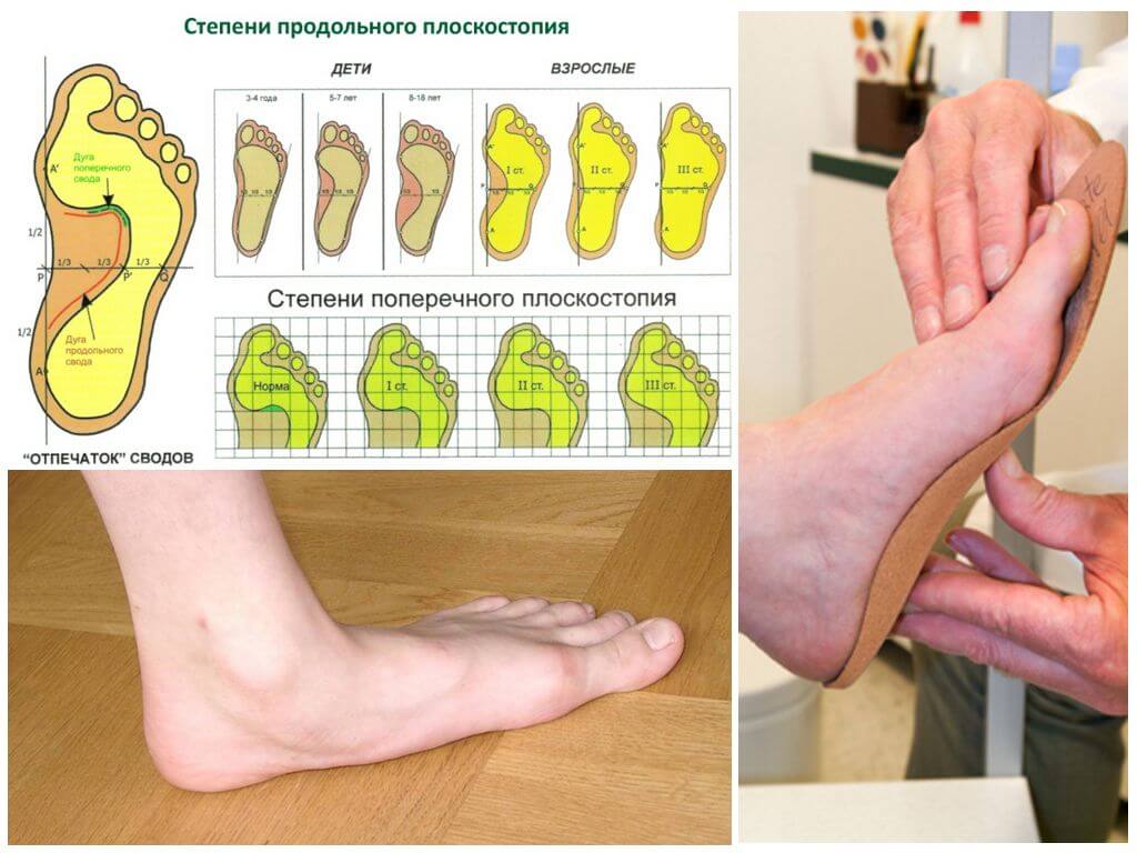 Лечение продольно-поперечного (комбинированного, смешанного) плоскостопия 