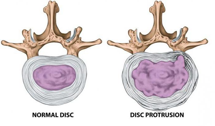 Лечение протрузии дисков шейного отдела позвоночника — движение избавит от проблем 