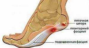 Лечение пяточной шпоры народными средствами 