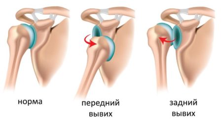 Лечение разрыва связок плечевого сустава: основы терапии 