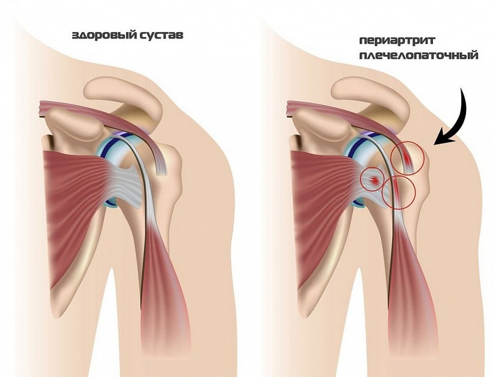 Лечение, симптомы и причины периартрита плечевого сустава 