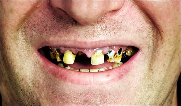 Алкоголь и сигареты: как они портят ваши зубы 