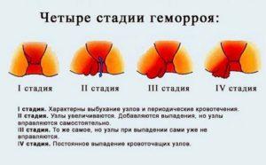 Основные причины, симптомы и методы лечения шишек в заднем проходе 