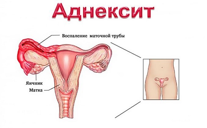 Особенности лечения острого и хронического аднексита 