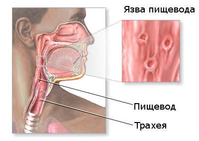 Первые признаки язвы пищевода 