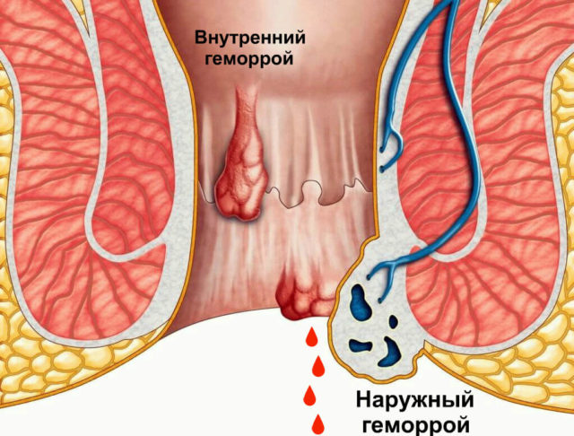 Почему появляется кровь на туалетной бумаге после посещения туалета? 