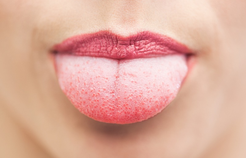 Почему щиплет язык: причины и способы лечения 