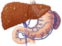 Портальная гипертензия при циррозе печени 