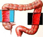 Причины и симптомы острого и хронического колита кишечника 