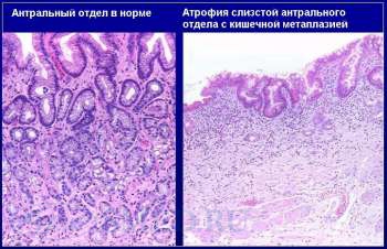 Причины кишечной метаплазии желудка, лечение и последствия 