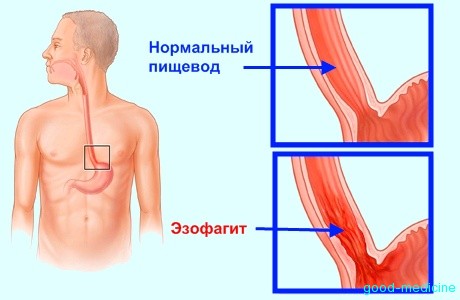 Причины, симптомы и лечение катарального эзофагита 