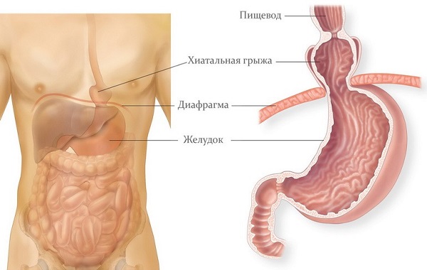 Причины возникновения и методы лечения грыжи пищевода 