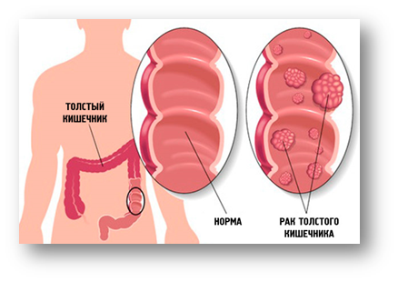 Профилактика paка толстой кишки 