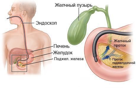 Ретроградная холангиопанкреа­тография (ЭРХПГ) 