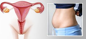 Серозометра матки в менопаузе: сущность, причины, симптомы, лечение 