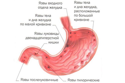 Симптоматика и лечение обострения язвы желудка 