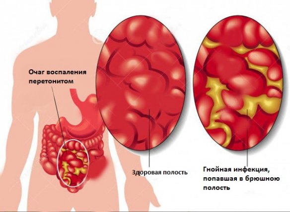 Симптомы и лечение гнойного перитонита кишечника 