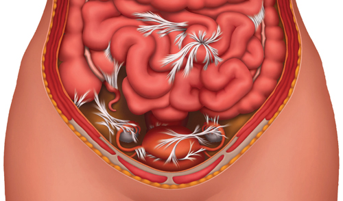 Спайки кишечника или спаечная болезнь: лечение опасной патологии 