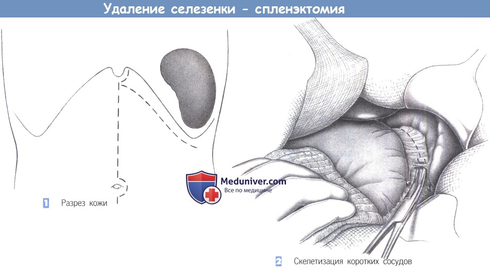 Спленэктомия (удаление селезенки): показания, операция, последствия 