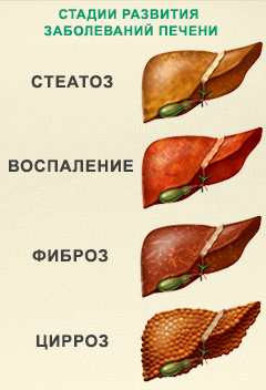 Стеатогепатоз печени 