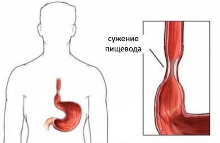 Стеноз пищевода: лечение, которое облегчает состояние пациентов 