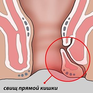 Свищ прямой кишки и его оперативное лечение 