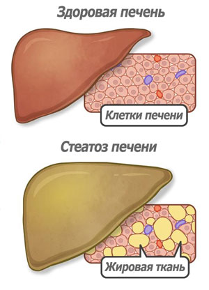 В чем опасность стеатоза печени, как его диагностировать и лечить 