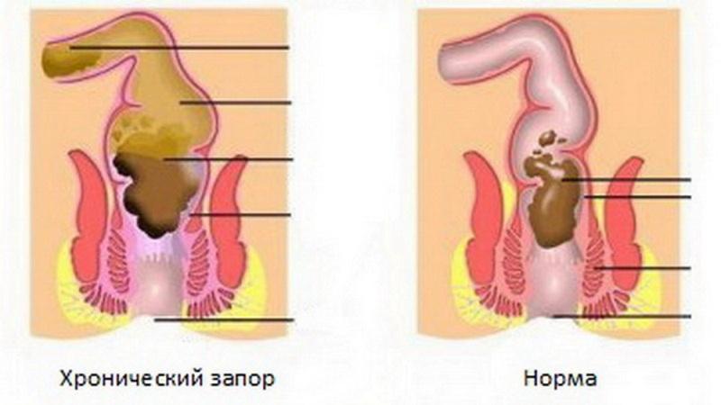 Как принимать мед при запорах 