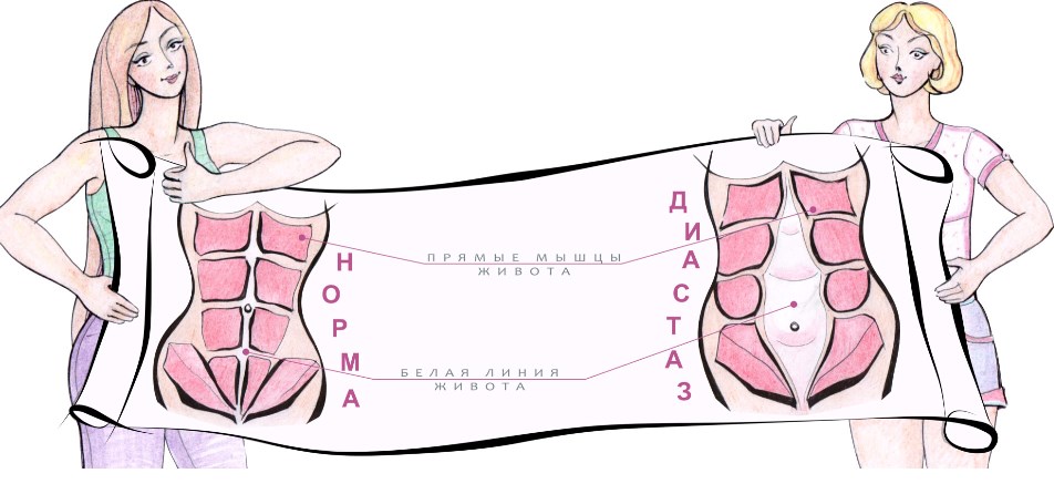 Лечение диастаза после родов 