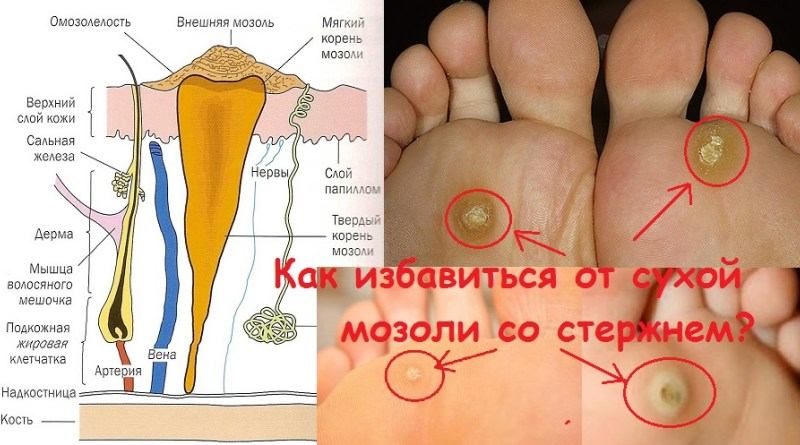 Лечение мозолей на ноге народными средствами. Причины и симптомы 