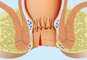 Чем лечить зуд в заднем проходе: обзор средств 