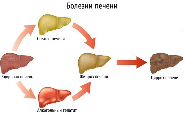 Что лучше Эссенциале форте или Карсил? 