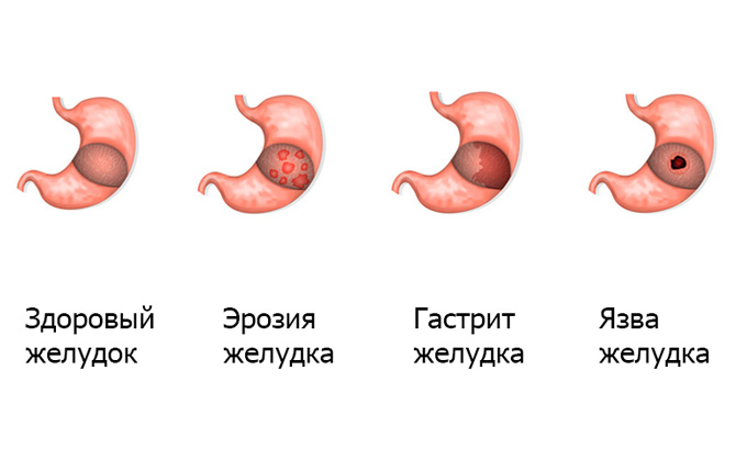 Диетическое питание при эрозивном гастрите желудка