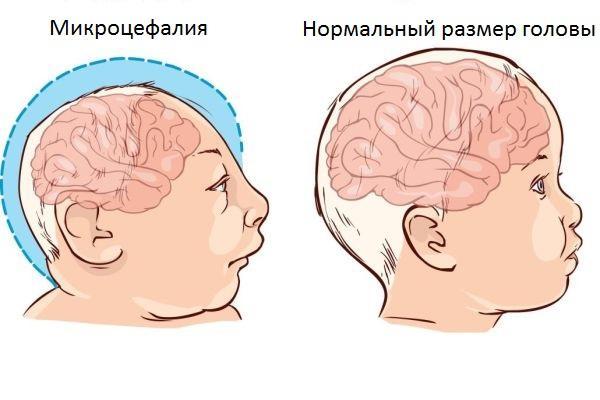 Микроцефалия у детей 