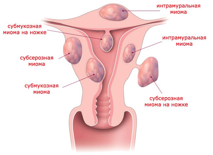 Миома и беременность 