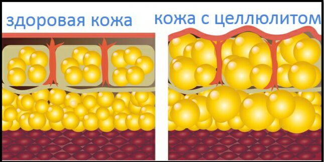 Можно ли делать антицеллюлитный массаж во время беременности 