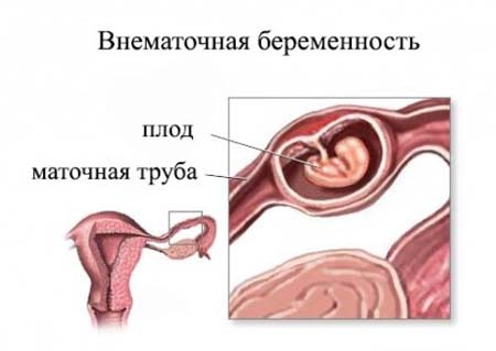 Можно ли выносить ребенка при внематочной беременности 